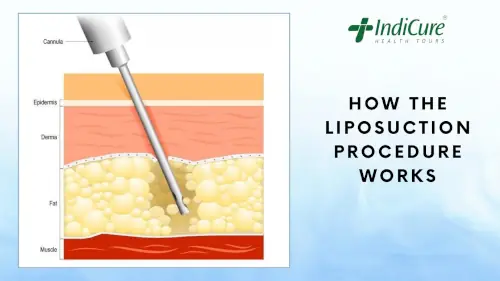 How the liposuction procedure works